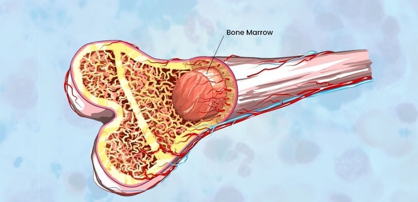 Bone Marrow Failure